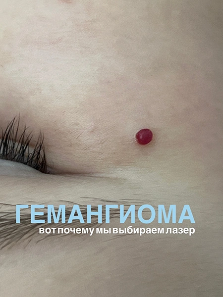 Кожа до процедуры по удалению гемангиомы